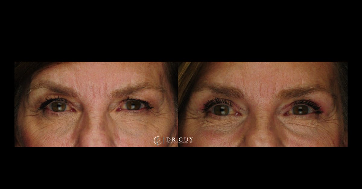 Upper Blepharoplasty Before & After Gallery - Patient 235735 - Image 5
