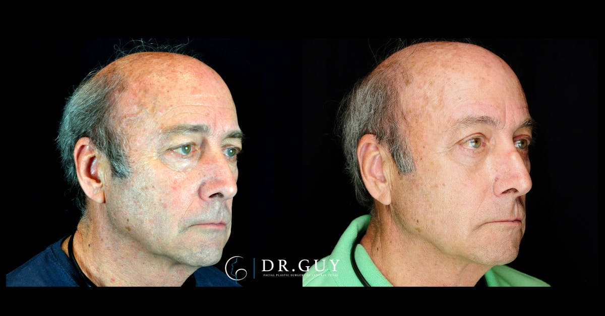 Fat Grafting Before & After Gallery - Patient 296944 - Image 2