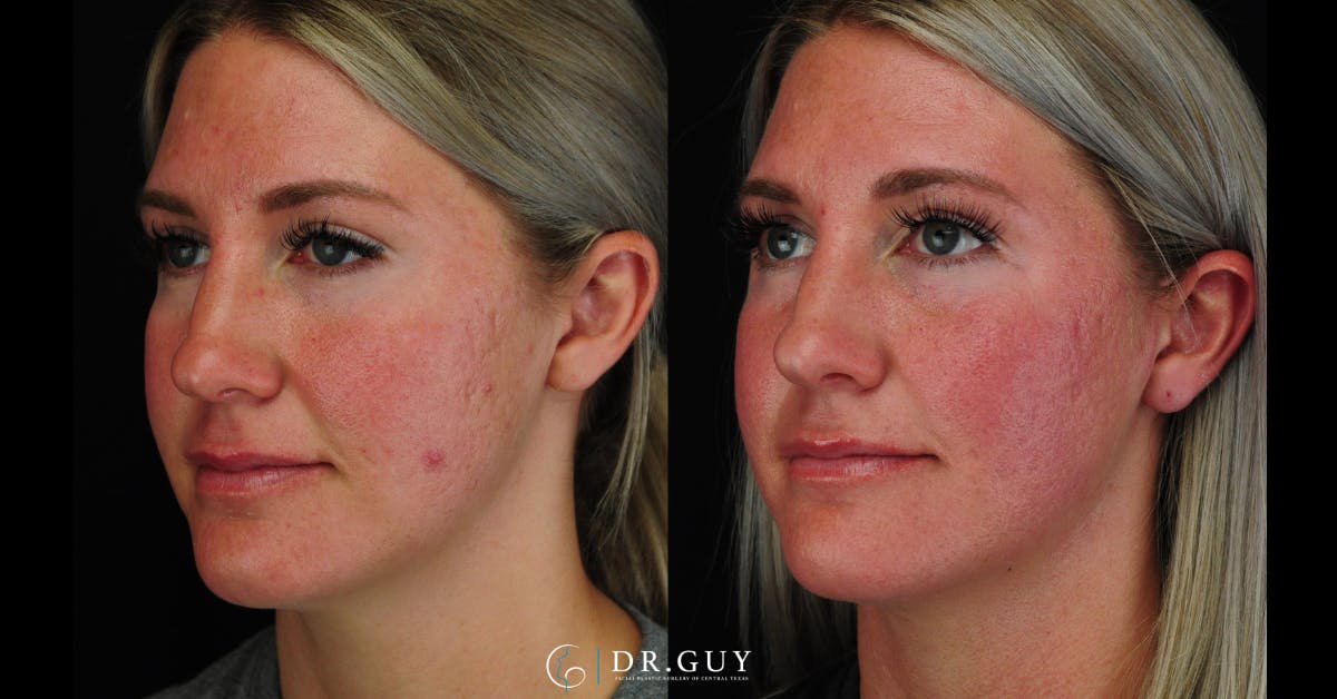 Morpheus8 Before & After Gallery - Patient 387466 - Image 5