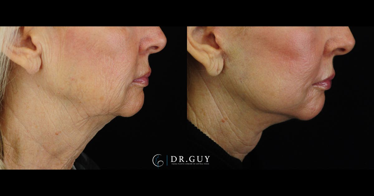 Laser Before & After Gallery - Patient 180288 - Image 4