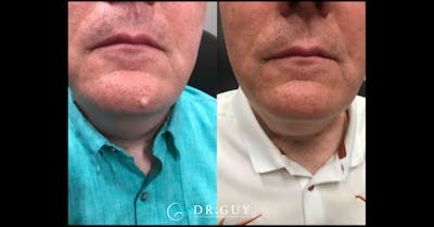 Mole Removal Before & After Gallery - Patient 201826 - Image 1