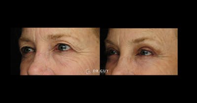 Upper Blepharoplasty Before & After Gallery - Patient 322359 - Image 1