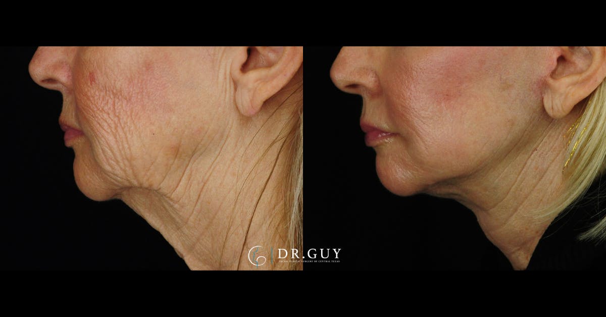 Laser Before & After Gallery - Patient 180288 - Image 5