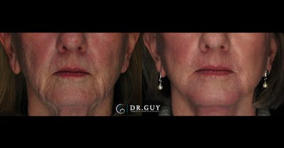 Laser Before & After Gallery - Patient 297836 - Image 1