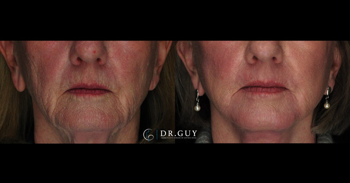 Laser Before & After Gallery - Patient 297836 - Image 1