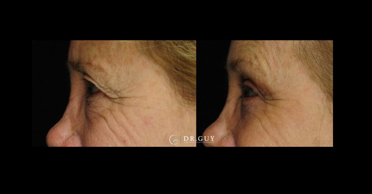 Upper Blepharoplasty Before & After Gallery - Patient 322359 - Image 4