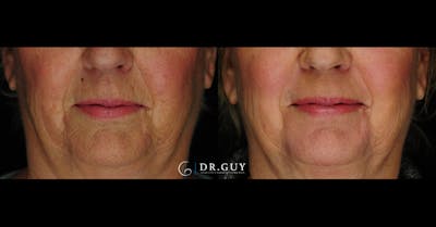 Laser Before & After Gallery - Patient 186476 - Image 1