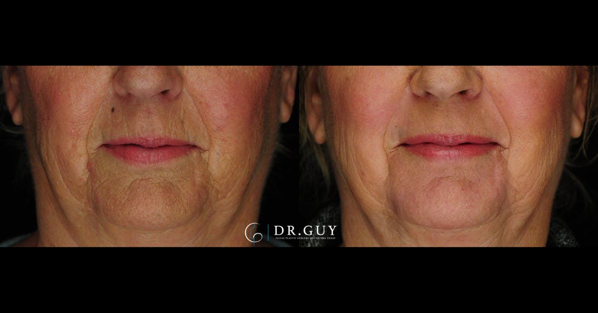 Laser Before & After Gallery - Patient 186476 - Image 1