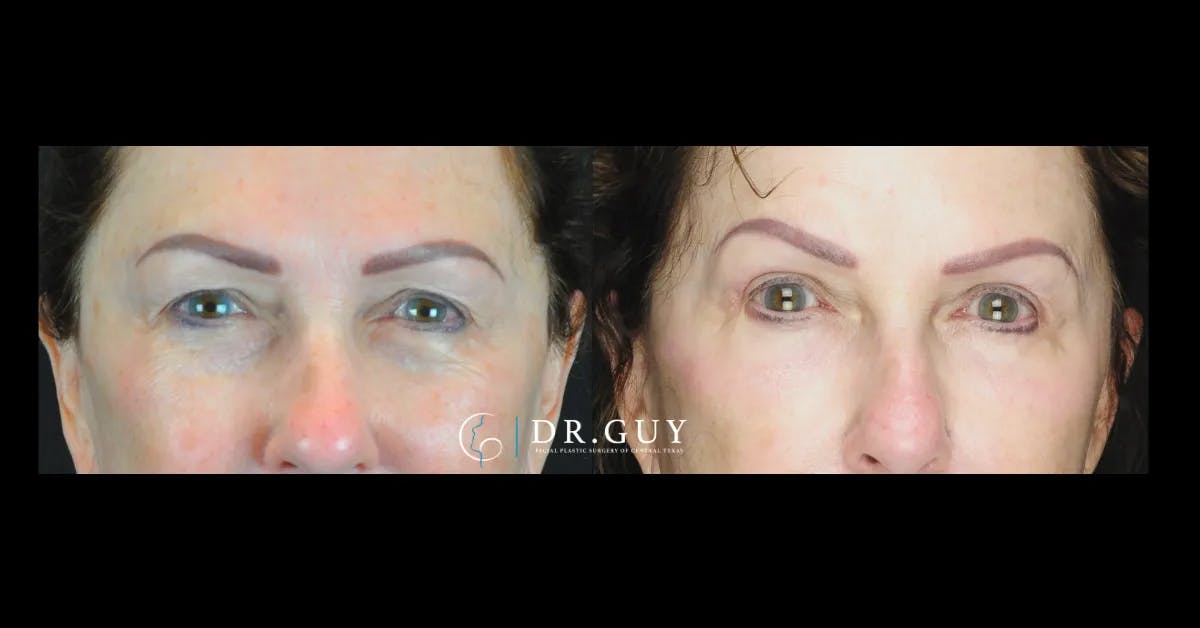 Fat Grafting Before & After Gallery - Patient 169831 - Image 1