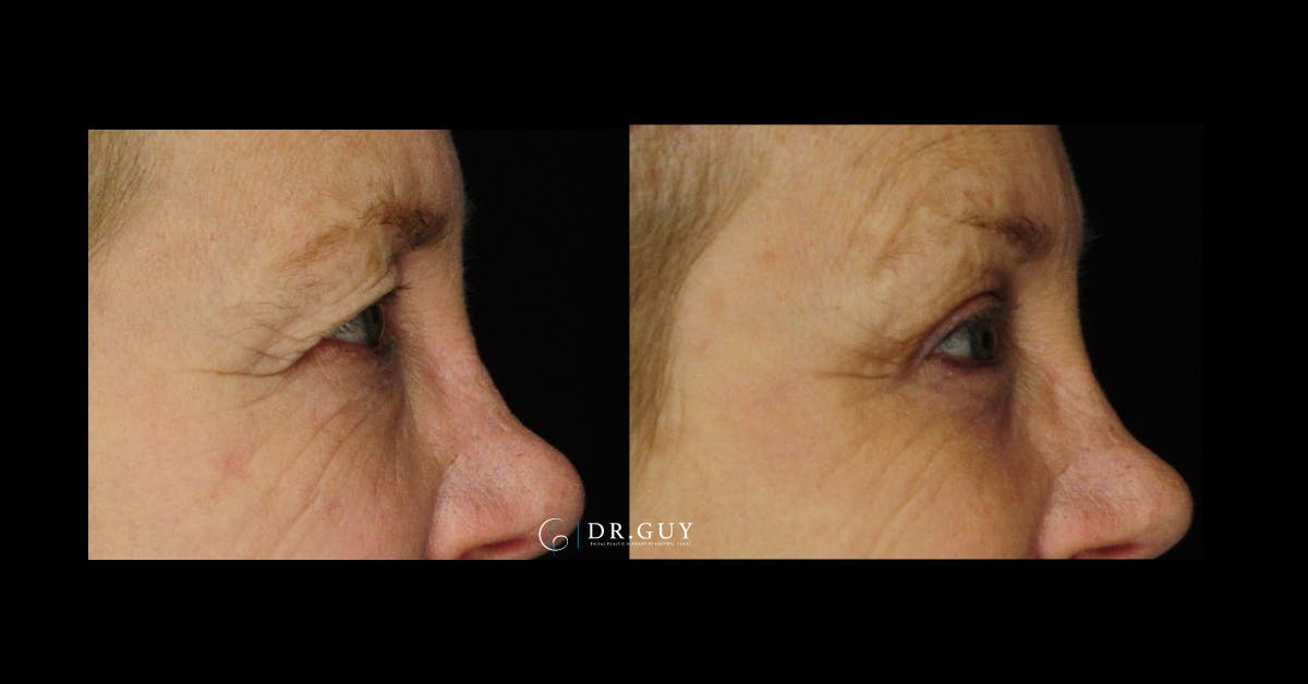 Upper Blepharoplasty Before & After Gallery - Patient 322359 - Image 5