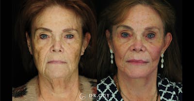 Laser Before & After Gallery - Patient 251658 - Image 1