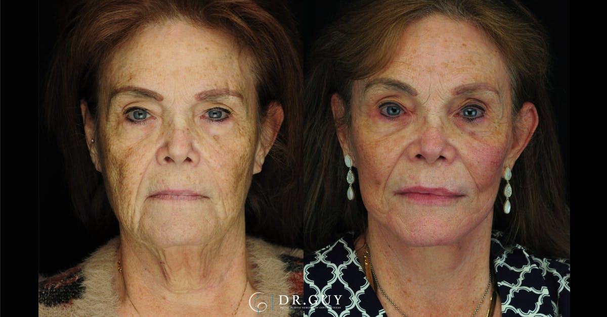 Laser Before & After Gallery - Patient 251658 - Image 1