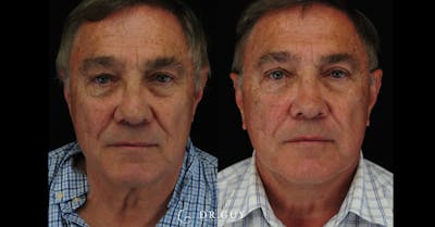 Upper Blepharoplasty Before & After Gallery - Patient 183973 - Image 1