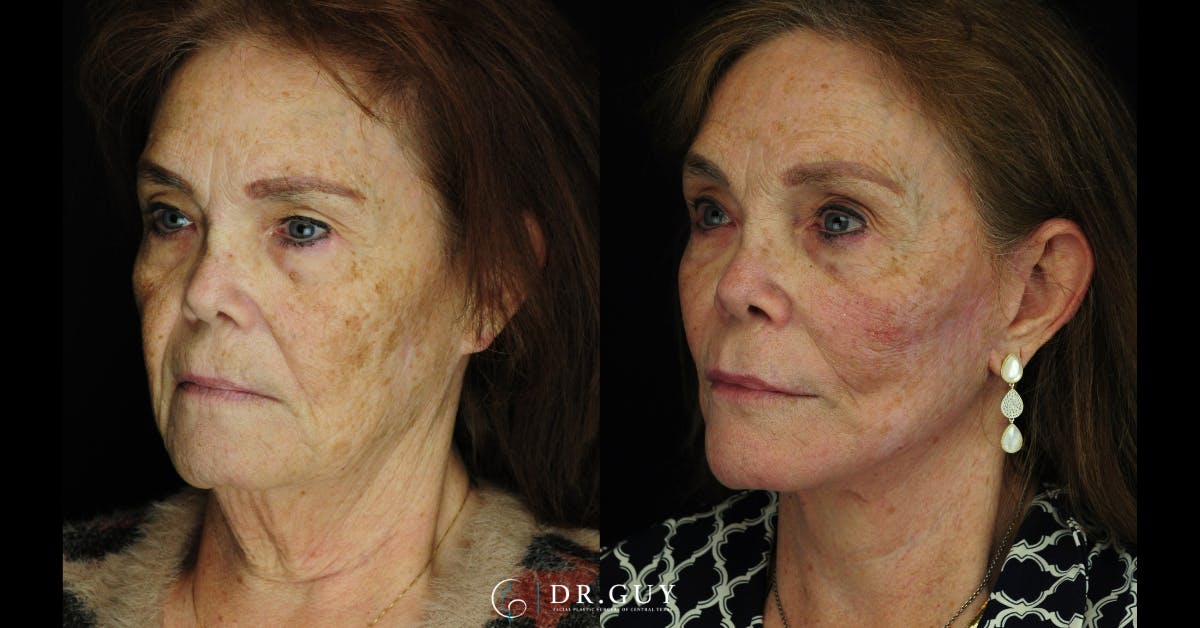 Laser Before & After Gallery - Patient 251658 - Image 2