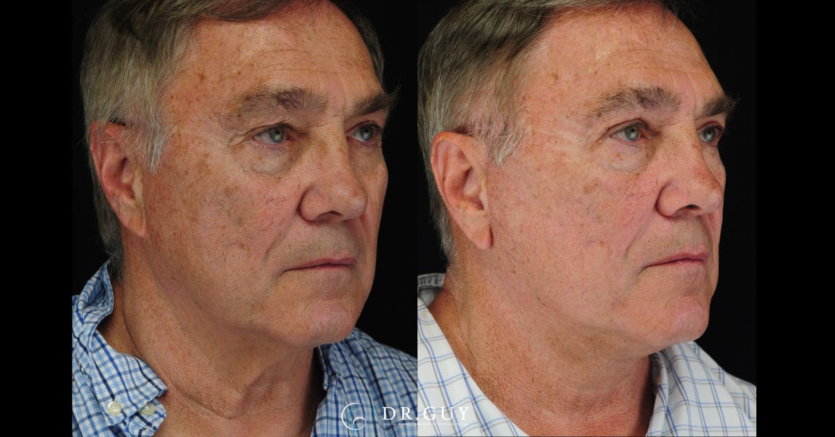 Upper Blepharoplasty Before & After Gallery - Patient 183973 - Image 2