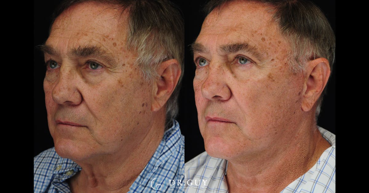 Upper Blepharoplasty Before & After Gallery - Patient 183973 - Image 3