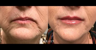 Fillers Before & After Gallery - Patient 245643 - Image 1