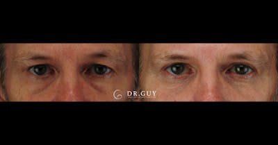 Upper Blepharoplasty Before & After Gallery - Patient 174688 - Image 1