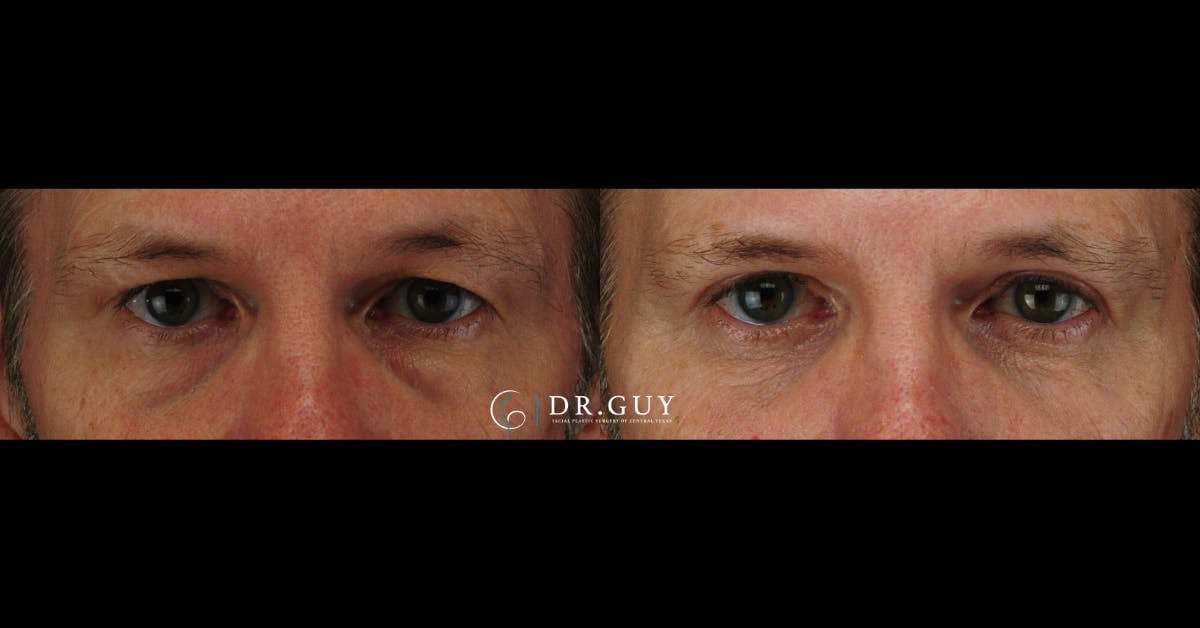 Upper Blepharoplasty Before & After Gallery - Patient 174688 - Image 1