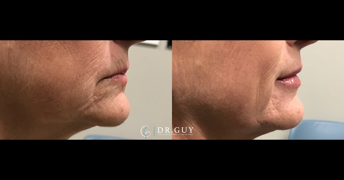 Fillers Before & After Gallery - Patient 245643 - Image 2
