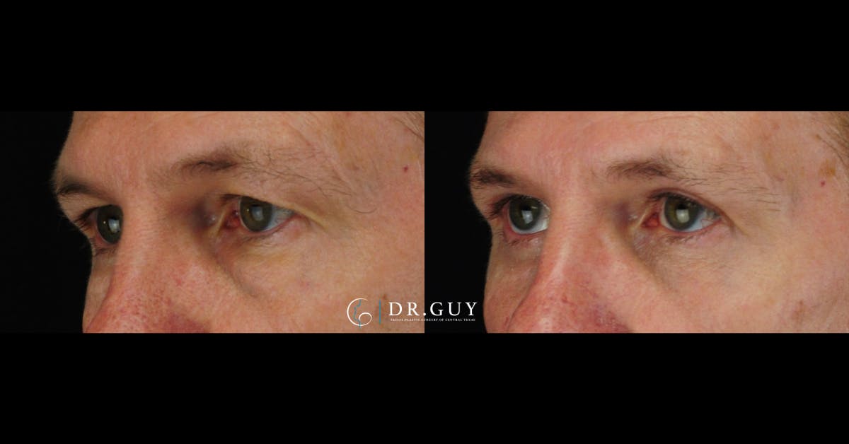 Upper Blepharoplasty Before & After Gallery - Patient 174688 - Image 2