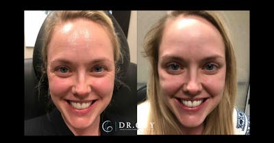 Neuromodulators Before & After Gallery - Patient 261710 - Image 1