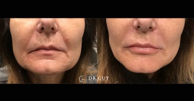 Fillers Before & After Gallery - Patient 494781 - Image 1