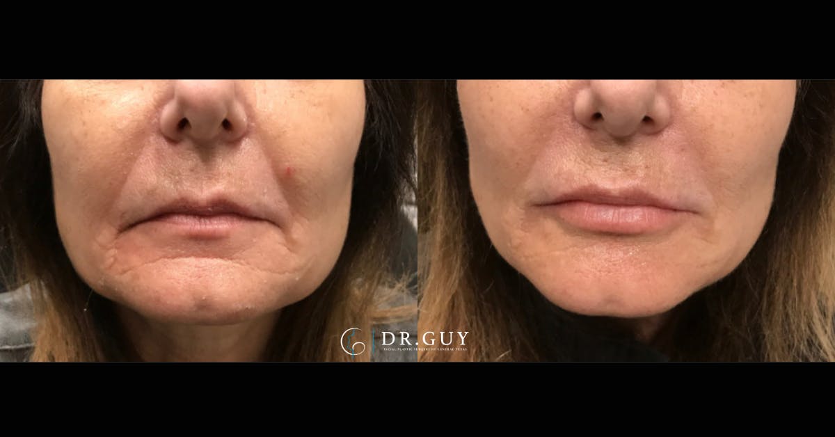 Fillers Before & After Gallery - Patient 494781 - Image 1