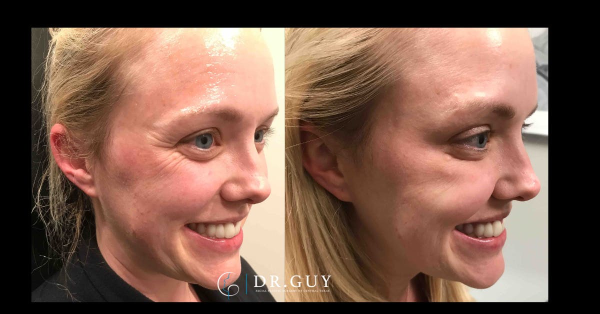 Neuromodulators Before & After Gallery - Patient 261710 - Image 2