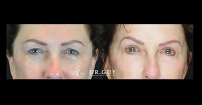 Upper Blepharoplasty Before & After Gallery - Patient 231530 - Image 1