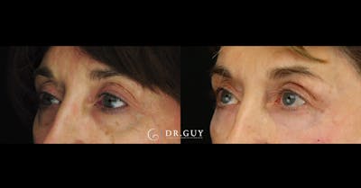 Fillers Before & After Gallery - Patient 385324 - Image 1