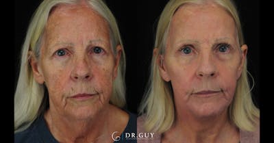 Laser Before & After Gallery - Patient 348138 - Image 1