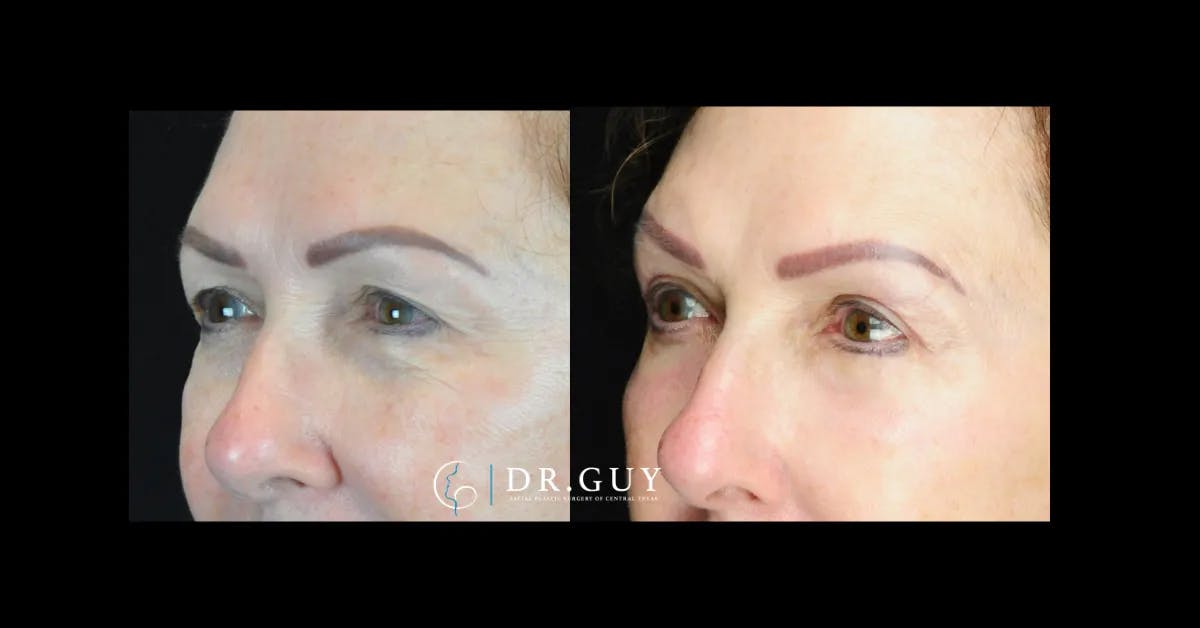 Upper Blepharoplasty Before & After Gallery - Patient 231530 - Image 2