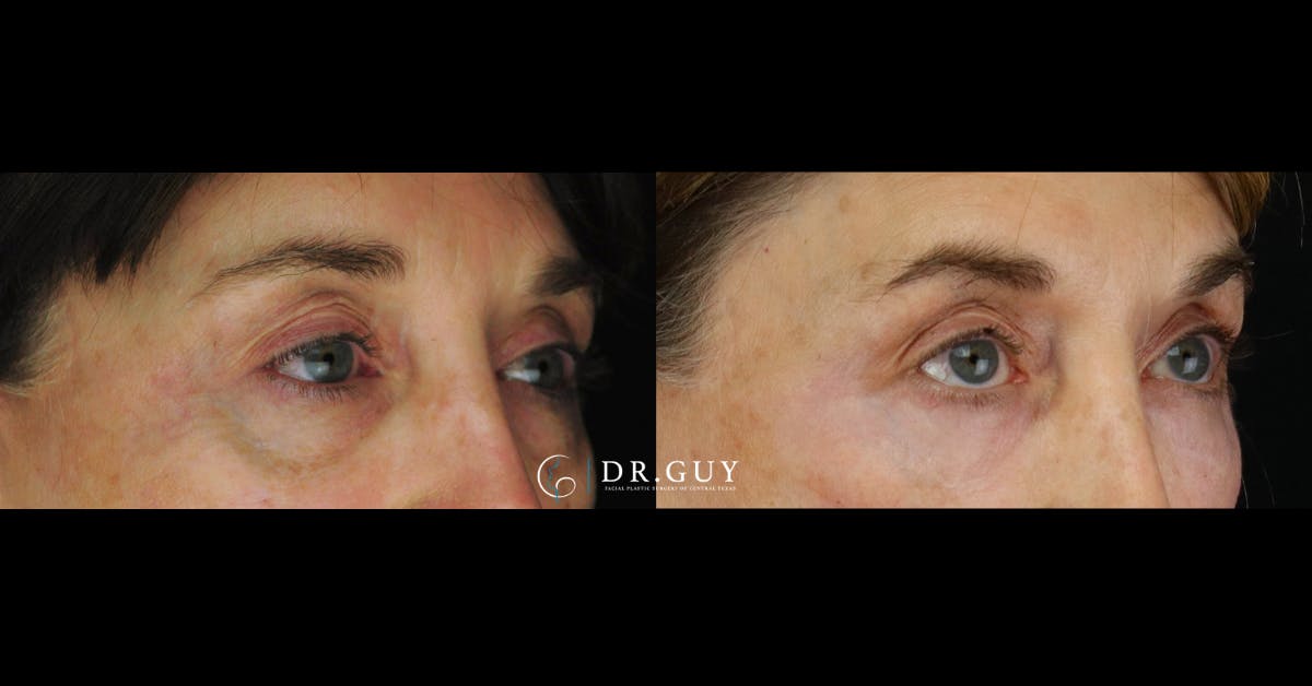 Fillers Before & After Gallery - Patient 385324 - Image 2