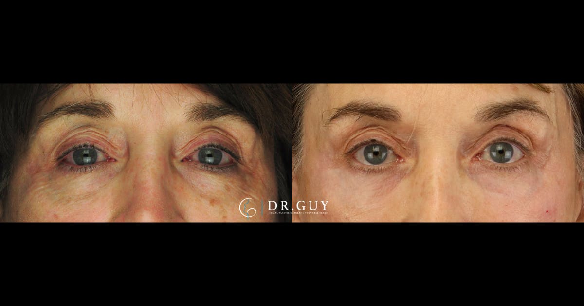 Fillers Before & After Gallery - Patient 385324 - Image 3
