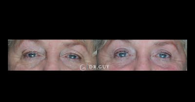 Upper Blepharoplasty Before & After Gallery - Patient 229756 - Image 1