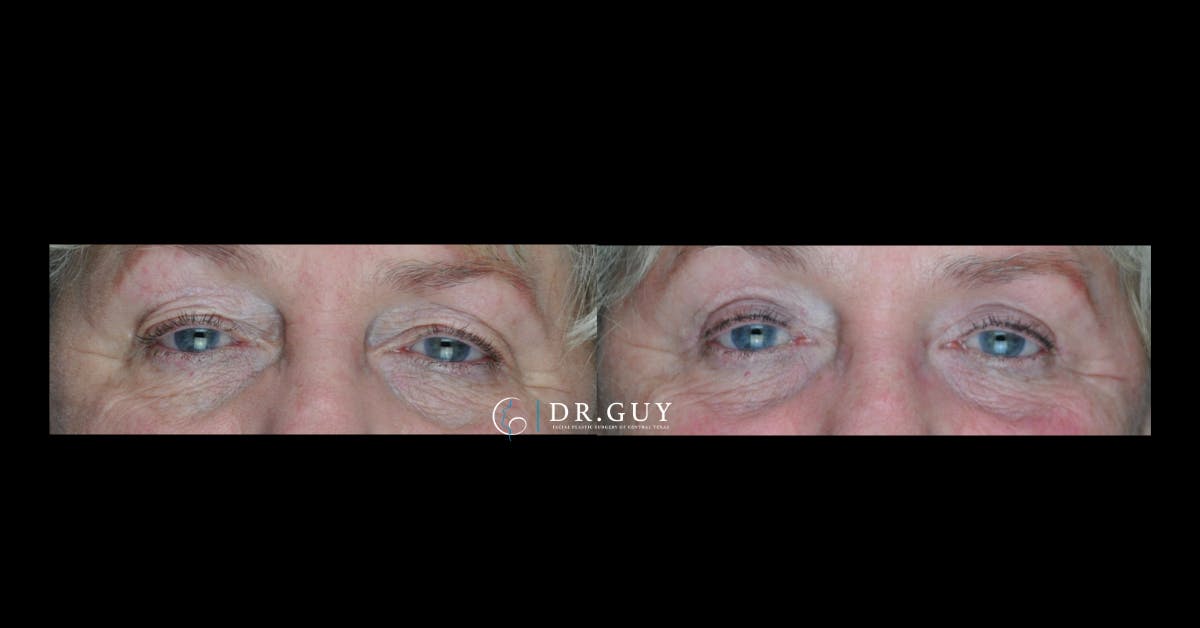 Upper Blepharoplasty Before & After Gallery - Patient 229756 - Image 1