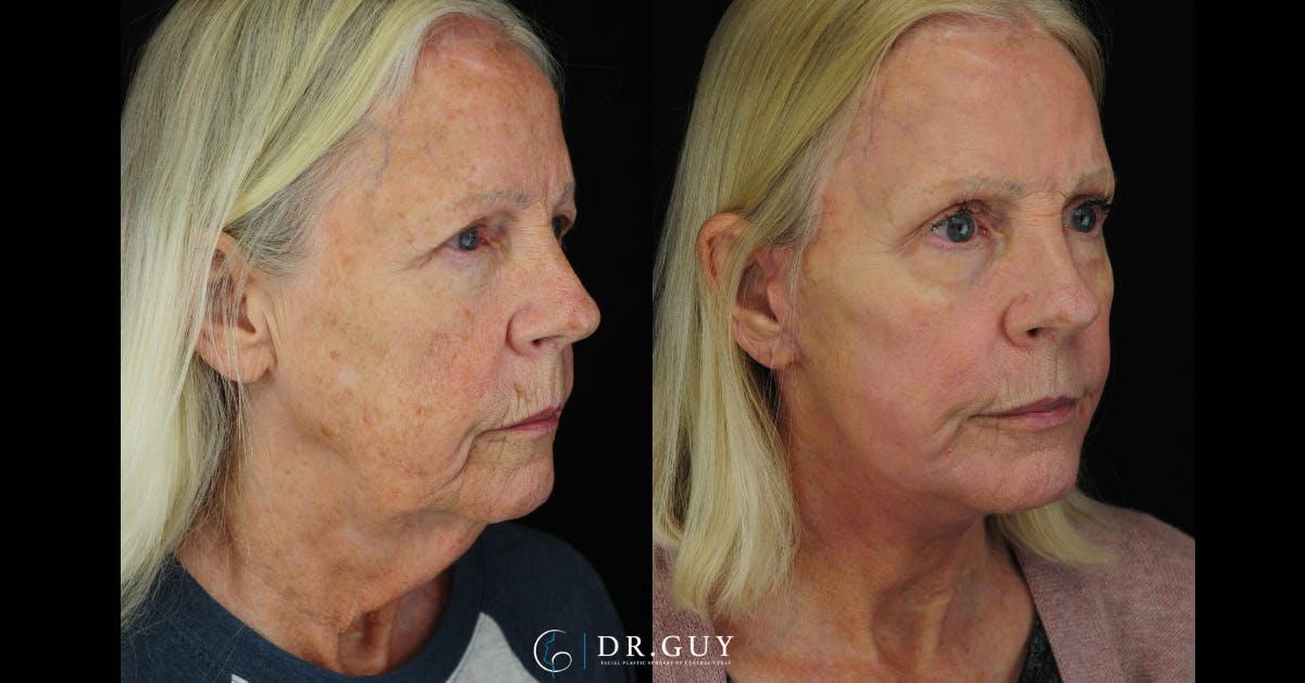Laser Before & After Gallery - Patient 348138 - Image 4