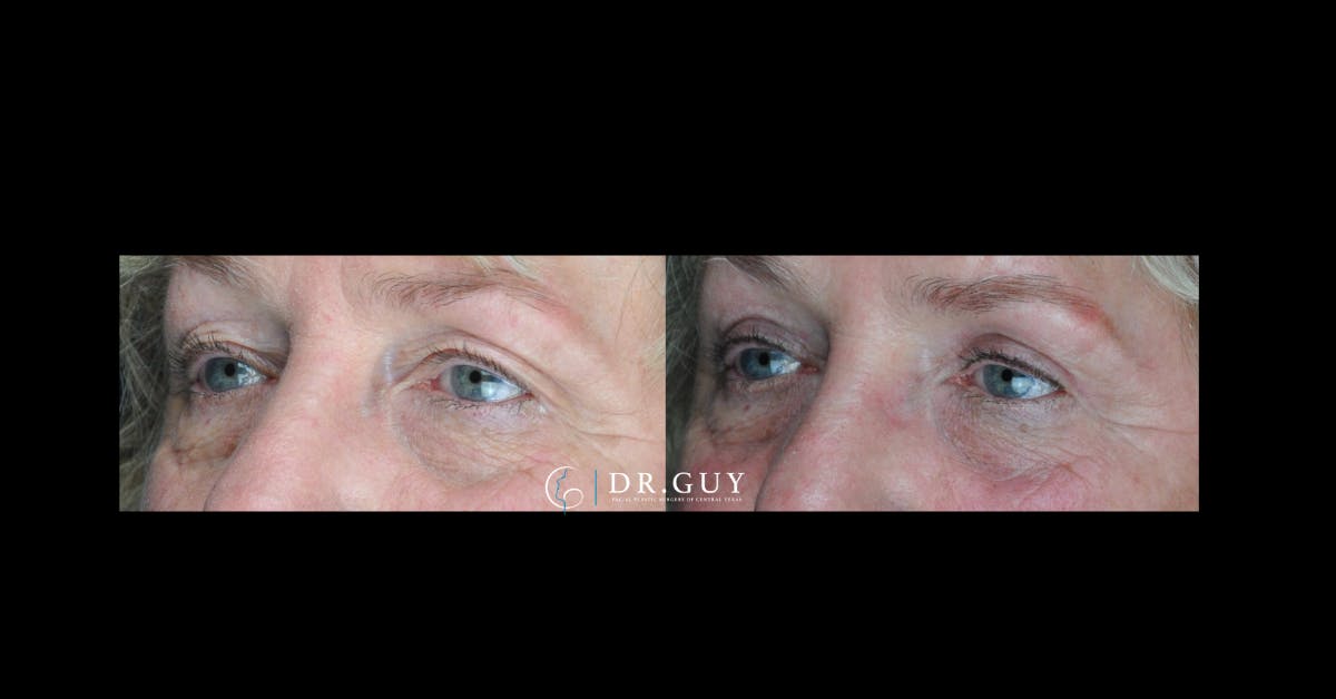 Upper Blepharoplasty Before & After Gallery - Patient 229756 - Image 2
