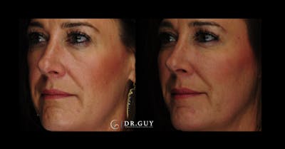 Fillers Before & After Gallery - Patient 449734 - Image 1