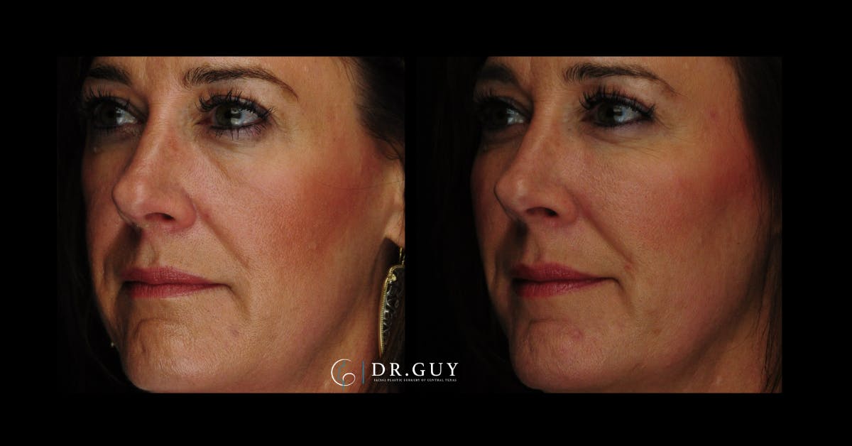 Fillers Before & After Gallery - Patient 449734 - Image 1