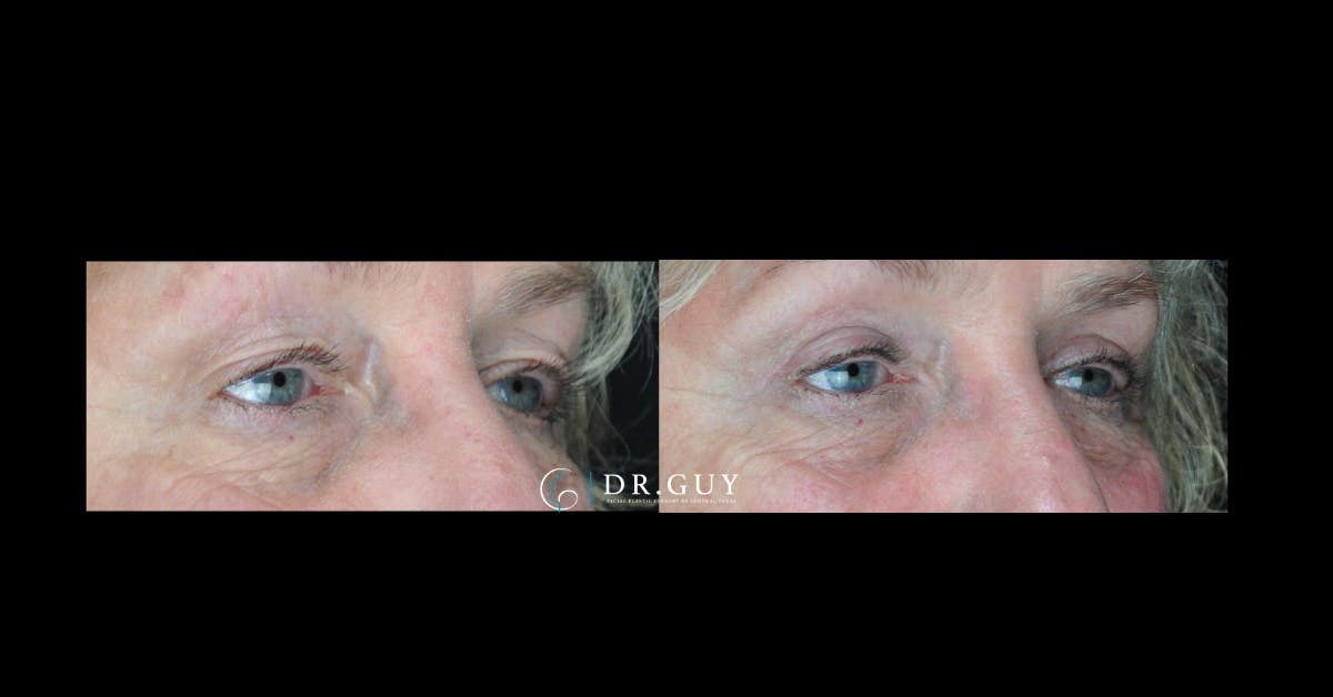 Upper Blepharoplasty Before & After Gallery - Patient 229756 - Image 3