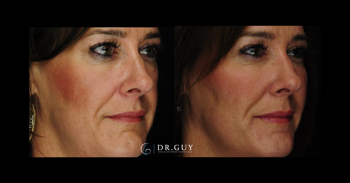 Fillers Before & After Gallery - Patient 449734 - Image 2