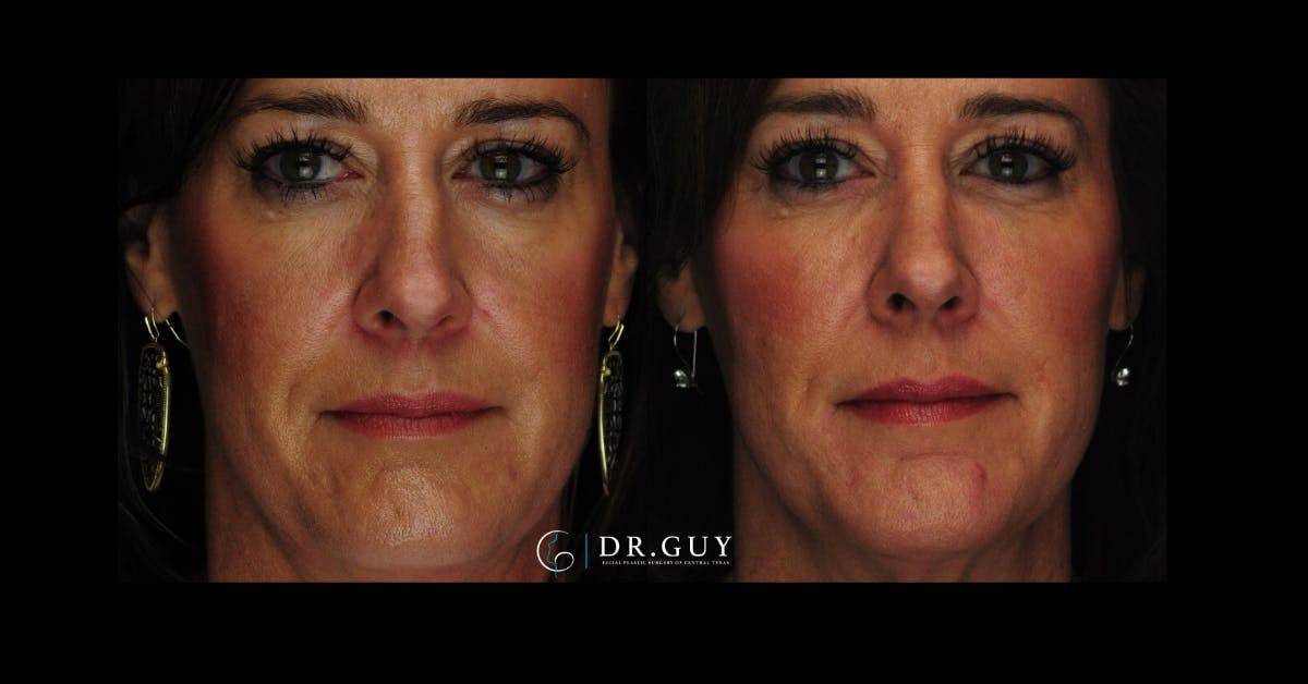 Fillers Before & After Gallery - Patient 449734 - Image 3