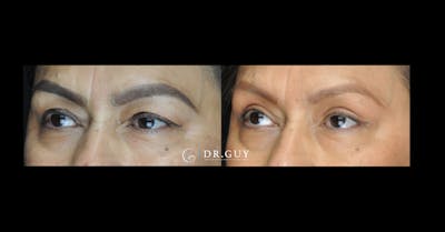 Upper Blepharoplasty Before & After Gallery - Patient 392372 - Image 1