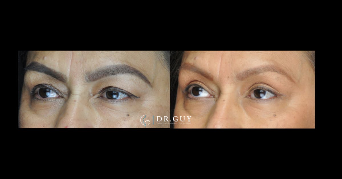 Upper Blepharoplasty Before & After Gallery - Patient 392372 - Image 1