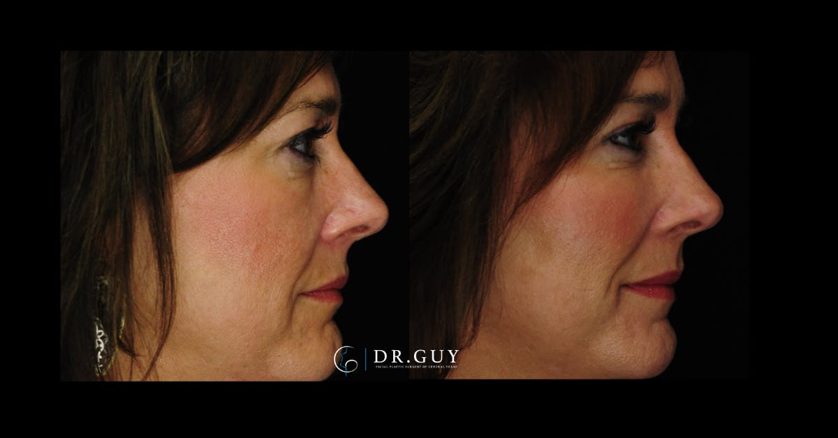 Fillers Before & After Gallery - Patient 449734 - Image 4