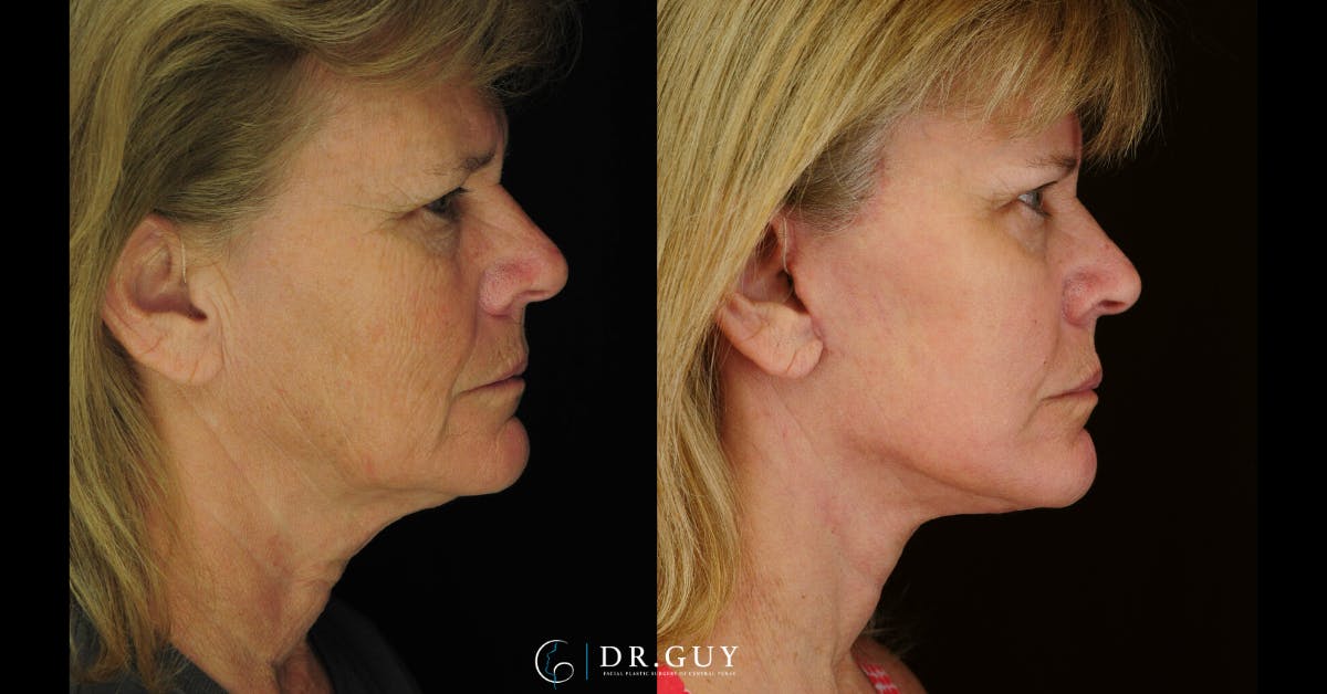 Laser Before & After Gallery - Patient 213737 - Image 2