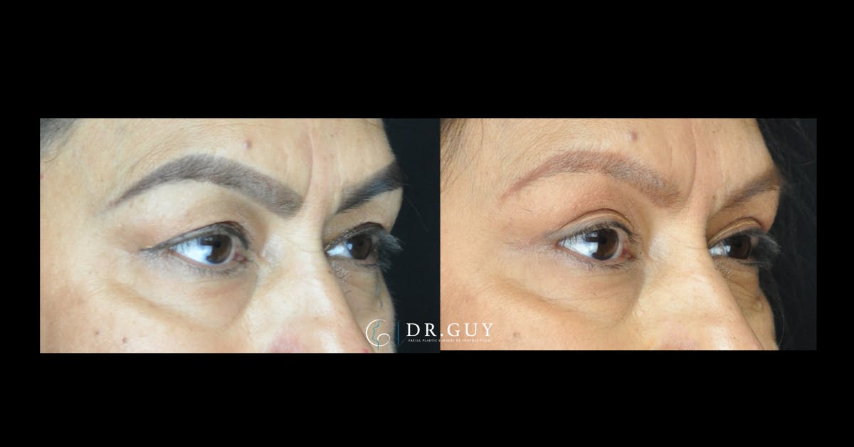 Upper Blepharoplasty Before & After Gallery - Patient 392372 - Image 2