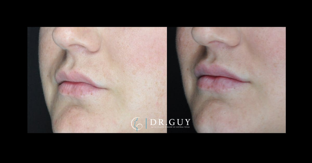 Fillers Before & After Gallery - Patient 588675 - Image 1